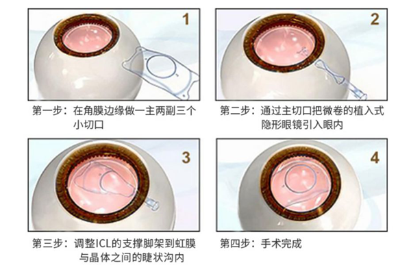 澳門近視手術選哪種,澳門近視手術哪家好,澳門近視手術排名,澳門眼科