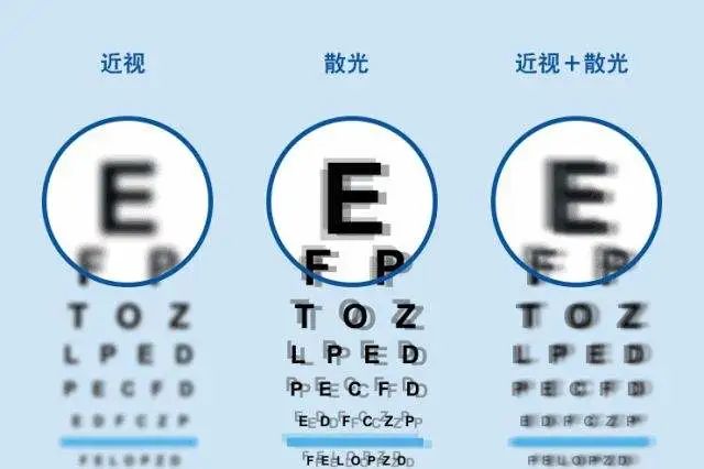 散光模糊重影癥狀