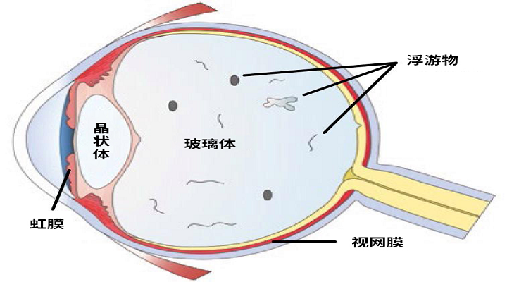 玻璃體渾濁示意圖