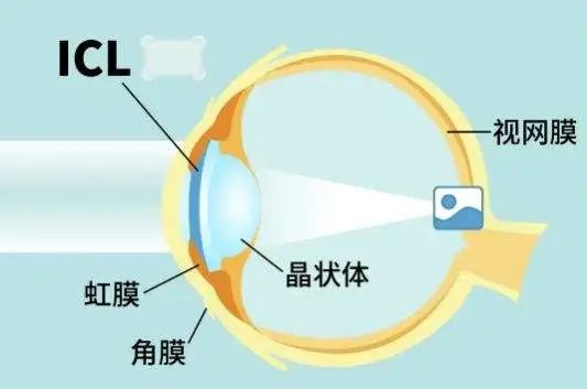 ICL晶體植入位置示意圖