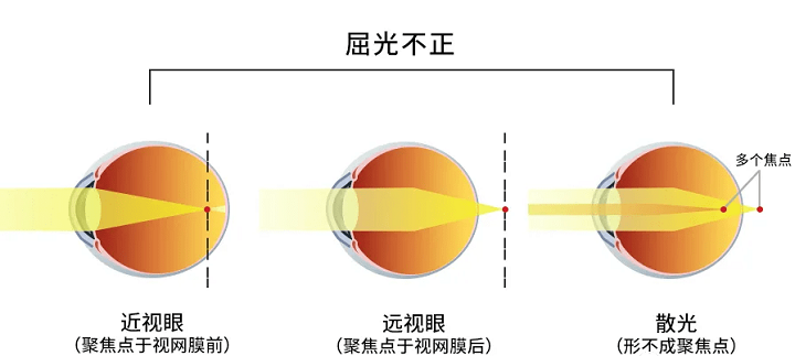 屈光不正