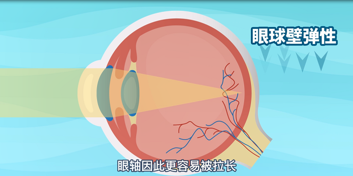 延緩孩子近視