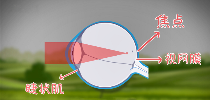 真、假性近視如何區分